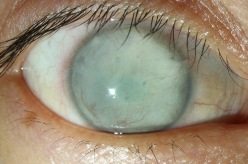 感谢郝燕生院长把我被判了死刑的眼睛救回来了