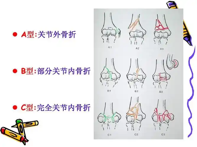 肱骨远端粉碎性骨折的手术治疗体会 (nxpowerlite)ppt_word文档在线阅