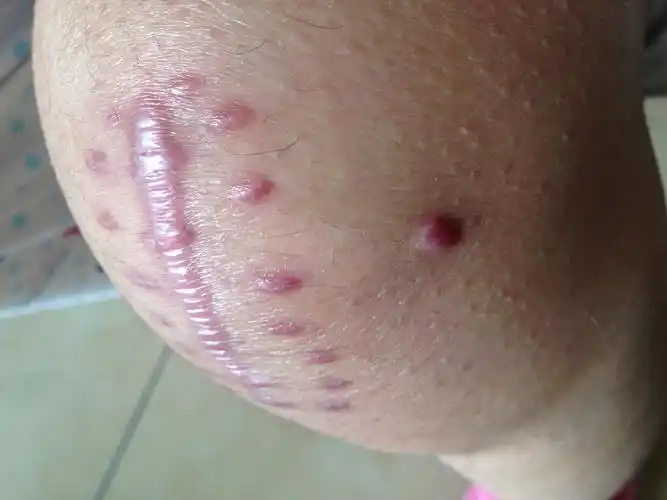 手术后一个月了,伤口和针眼有点鼓起来的样子,正常不?之后会消下去吗?