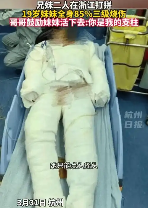 19岁女孩全身85%烧伤,治疗费用需上百万,一天内收到捐款150万