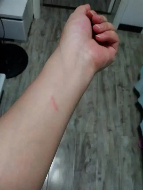 我说手怎么这么疼原来被油烫了girlangry