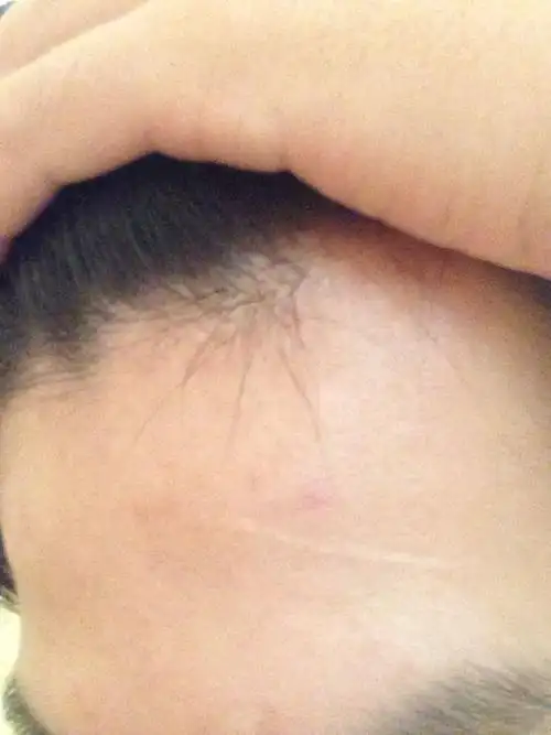 有疤痕不能当兵吗,如图片我额头小时候被树枝划伤的 面积不大疤也不深