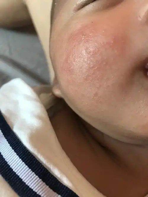 请问大家宝宝脸上是奶癣吗?