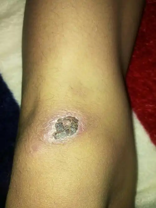 腿上这伤疤,当兵体检过得去吗?