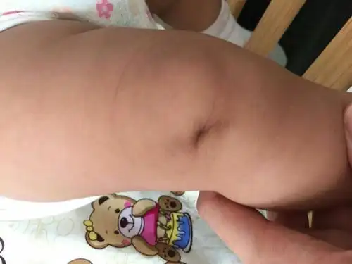 我家宝宝膝盖有窝,四个月了,大家看看正常不?