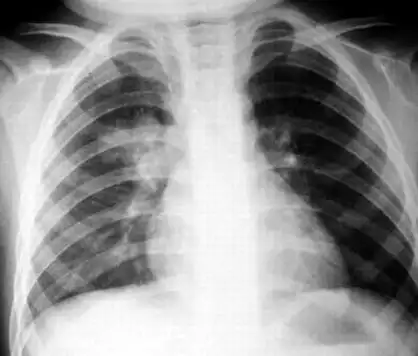 展开全部 支气管肺炎是儿童尤其是婴幼儿常见的感染性疾病,是儿童