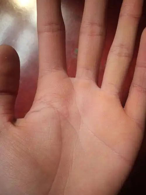 手心泛黄,怎么回事?