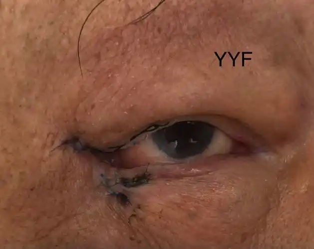 上颌窦恶性肿瘤切除术后的眼睑缺损修复&鼻眶沟通肿瘤_上颌窦癌_上颌