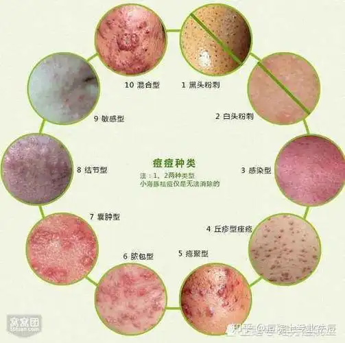 痘痘肌们说出自己的心声