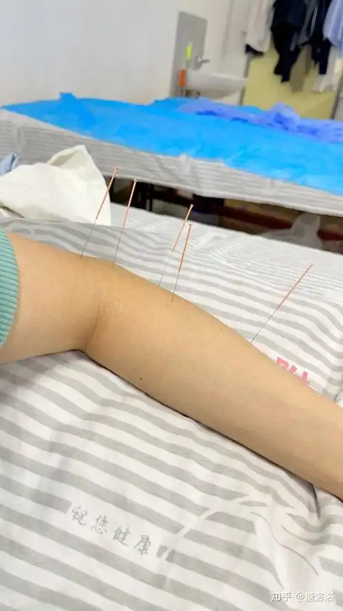 我是针灸小能手