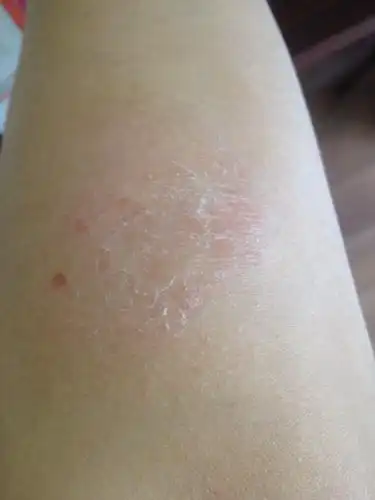 手臂上有一小块很干,有时候很痒,抓了掉皮屑.请教大神,这是什么鬼?