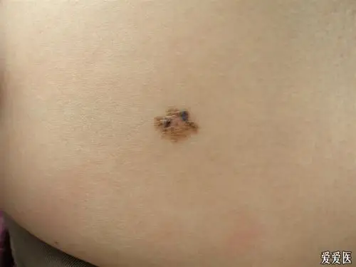 典型病例交流22 浅表性基底细胞癌 - 皮肤及性传播疾病讨论版 - 爱爱