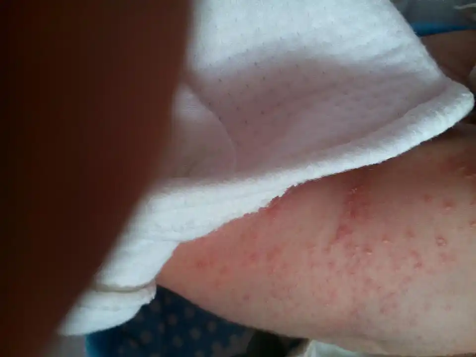 出生十天的婴儿屁股上有红疙瘩是怎么回事