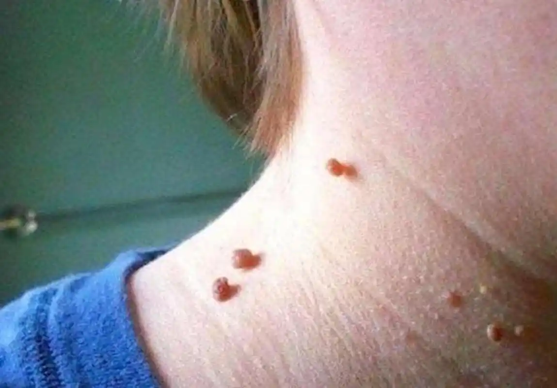 脖子上长的丝状小肉粒是什么?丝状疣和皮赘,医生教你根除方法