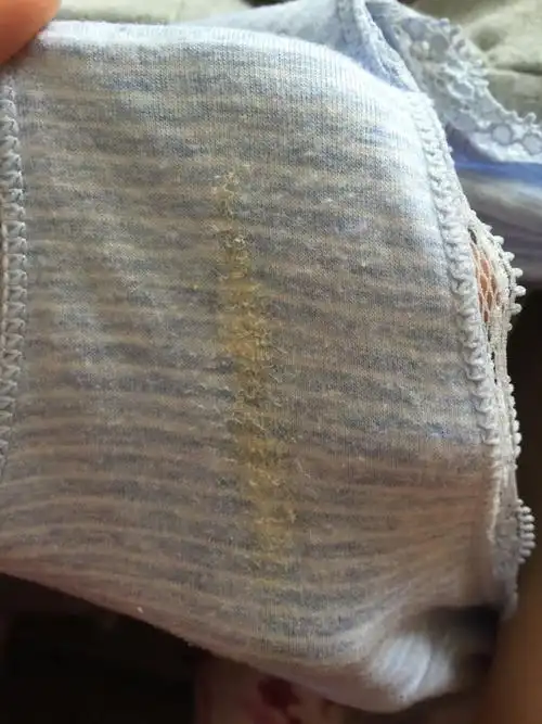 有些时候左边小腹有点疼,内裤总是黄黄的,白带干在内裤上黄黄干干的