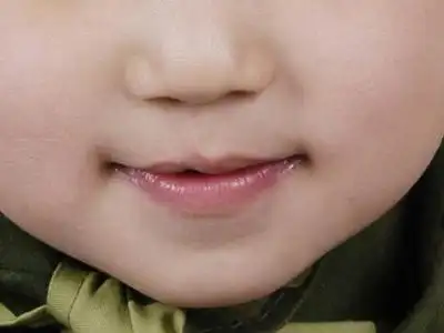 因为唇腭裂患儿中,约有4.