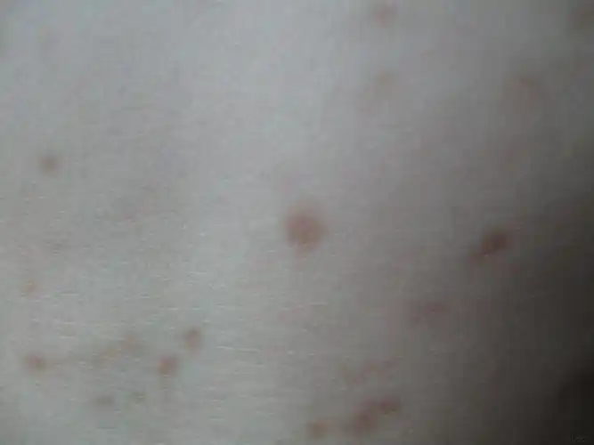 请您诊断 - 皮肤及性传播疾病讨论版 - 爱爱医医学论坛