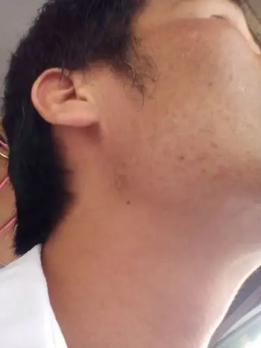 下巴两侧胡子越刮越粗加上又长斑很难看,我用夹子夹了,我想以后不长