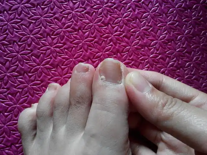 脚趾甲分层长,但不疼,想知道怎么回事