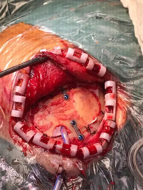 小骨窗开颅治疗脑出血一例病人