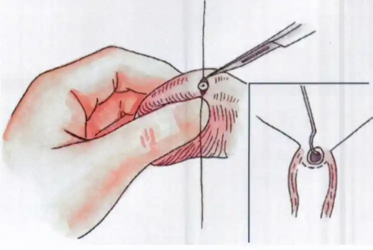 男性结扎手术简单,为何很多医院不做?