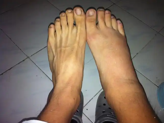 崴脚第三天了,很严重,小腿和脚踝都肿了,用了一天云南白药脚踝不太肿