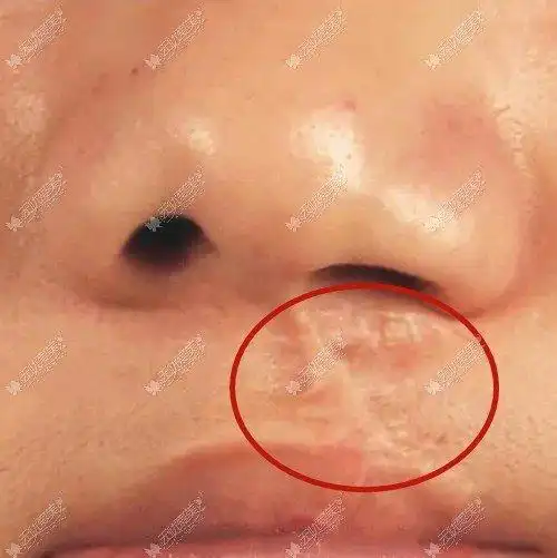 唇腭裂疤痕修复需要多少钱取决于你选择哪种方法去除