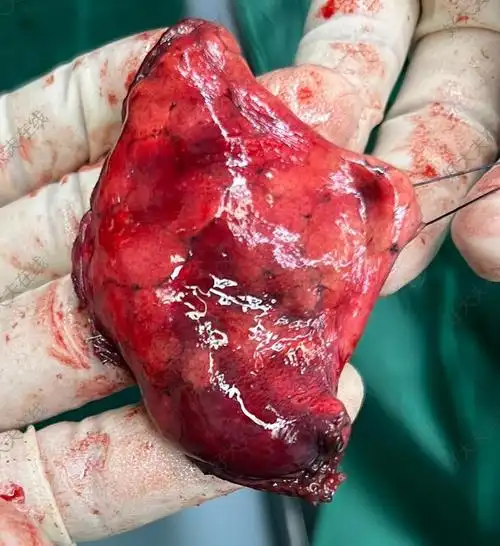 rs8a 切除_肺部结节 - 好大夫在线