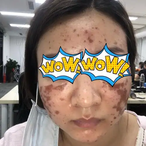 在该医院坐果酸换肤美白项目被毁容脸部皮肤大面积被烧伤