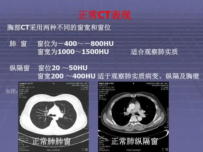 正常胸肺部ct影像学表现ppt