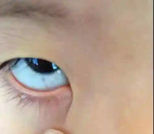 为什么眼睛是蓝色的女性眼白发蓝有预示性