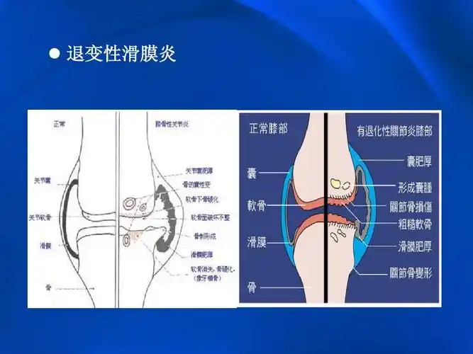 膝关节滑膜病变mrippt