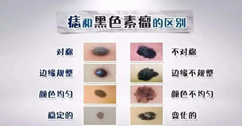 如何分辨黑色凸起痣的良恶性?4点快速辨别!