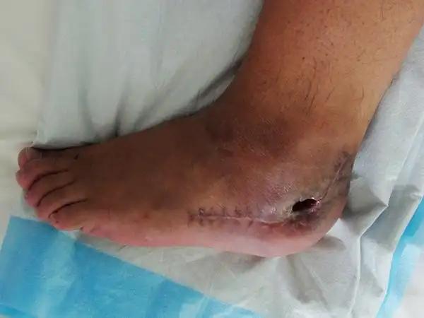 跟骨骨髓炎是怎么回事呢?