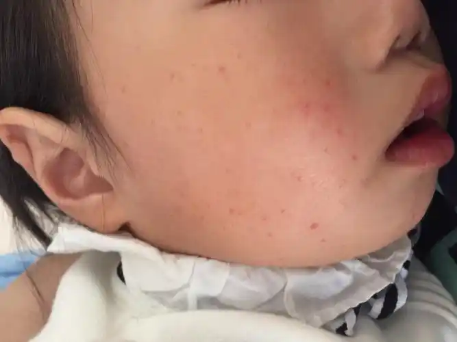 部分信息和图片因保护患者隐私已被医生屏蔽您好,过敏性紫癜一般不长