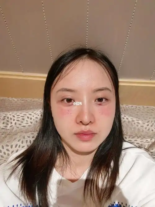 填充泪沟消肿～_泪沟_消肿_胶原蛋白_华为怎么样_美颜_相机_海鲜_淡妆