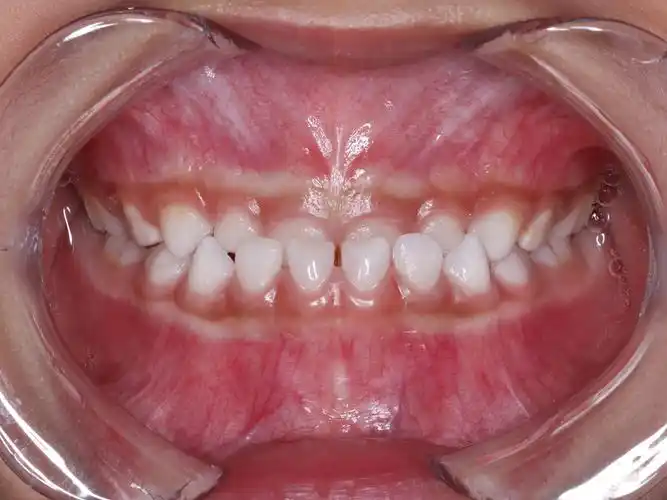 牙颌畸形_介绍_治疗方式 - 好大夫在线