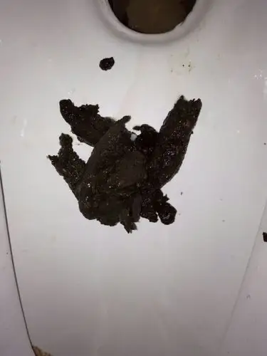 今天拉大便是黑色的!有点担心.会是身体什么问题吗