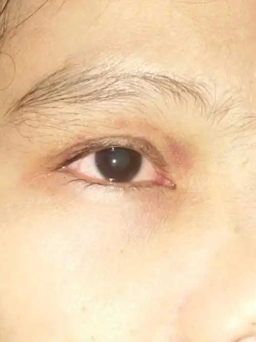 眼睛被衣架打伤了,看东西蒙蒙的,瞳孔散大,有混浊,请看下图,这样的