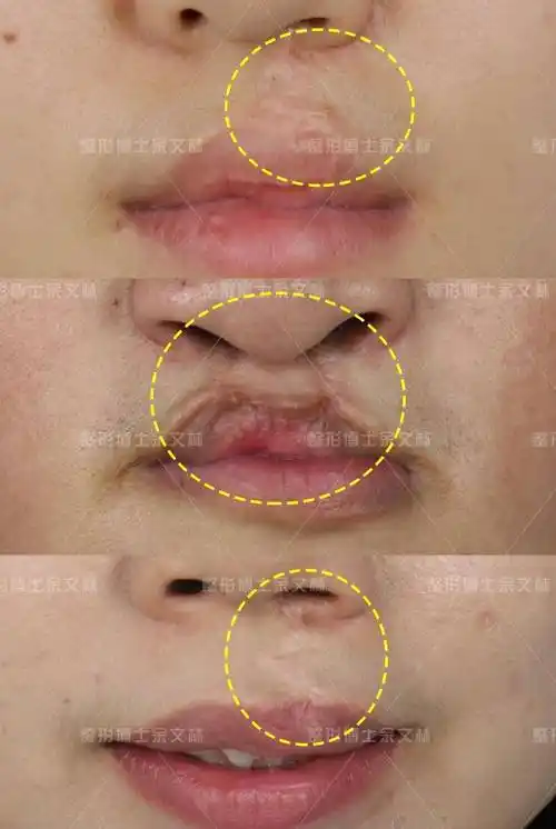 唇裂一期修复手术后疤痕明显怎么办