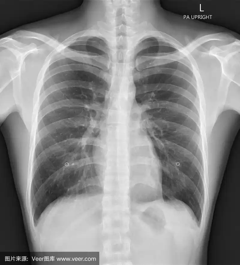 正常胸片x光
