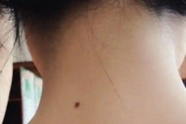 人的脖子后面为什么会有一颗痣这是好事还是坏事建议了解