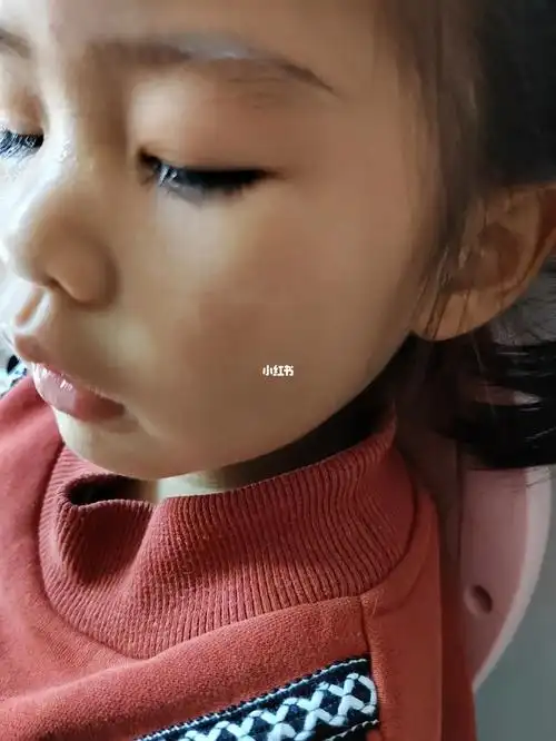 宝宝皮肤不均匀是什么情况