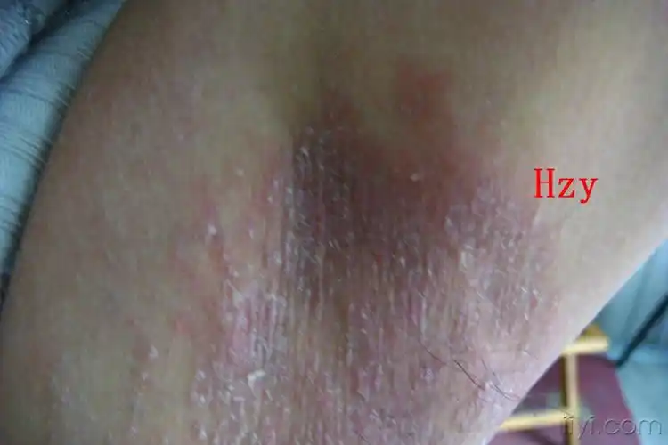 皮肤及性传播疾病讨论版 - 爱爱医医学论坛