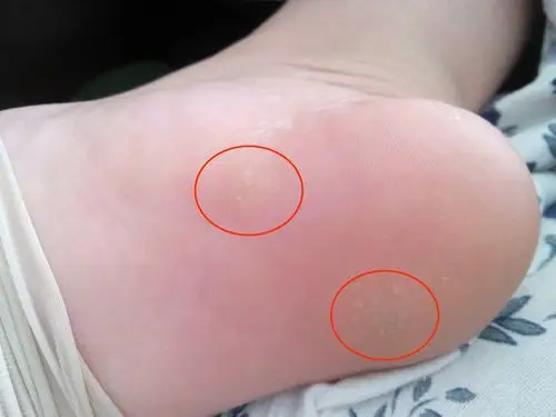 有谁知道我脚底上的这个是什么东东,指甲盖大小的硬块.不碰不痛.