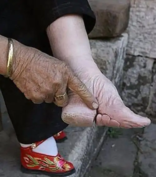 揭开三寸金莲血泪史终于有人愿意松开裹脚布用x光看惊悚到像是p出来
