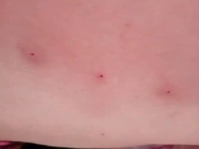 针扎的痛你经历过吗