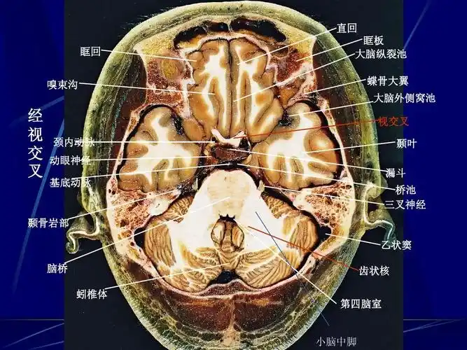 颅脑横断层解剖和ct,mri 直回 眶回 嗅束沟 眶板 大脑纵裂池 蝶骨大翼