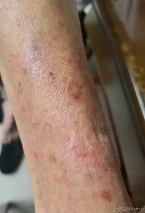 干燥综合症还是免疫力低下引起来的瘙痒