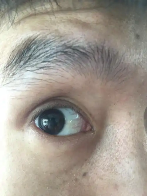 白眼球部位发黄,类似黄色斑块,看远处眼前有类似蜘蛛网一样的黑影,不